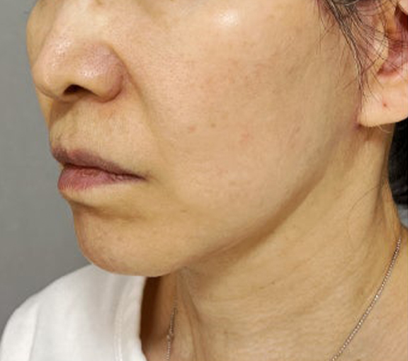 症例写真,ミニフェイスリフトとあご下の脂肪吸引を行った症例写真,After（3ヶ月後）,ba_minilift028_b02.jpg