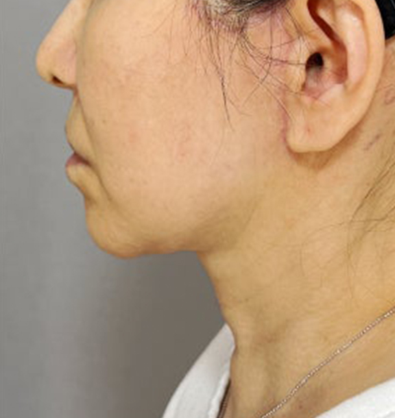 症例写真,ミニフェイスリフトとあご下の脂肪吸引を行った症例写真,After（3ヶ月後）,ba_minilift028_b03.jpg
