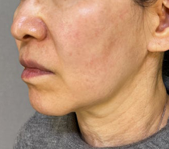 症例写真,ミニフェイスリフトとあご下の脂肪吸引を行った症例写真,Before,ba_minilift028_b02.jpg