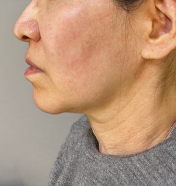症例写真,ミニフェイスリフトとあご下の脂肪吸引を行った症例写真,Before,ba_minilift028_b03.jpg