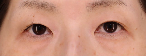 目の下の切らない脂肪取りを行った40代女性の症例写真,Before,ba_shibo_under018_b01.jpg