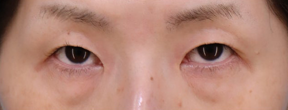 症例写真,目の下の切らない脂肪取りを行った40代女性の症例写真,Before,ba_shibo_under018_b02.jpg