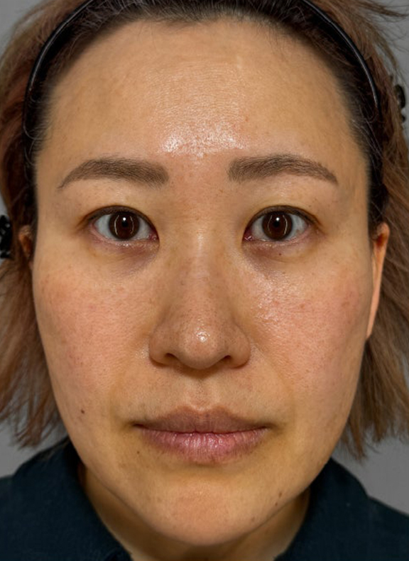 イタリアンリフト、あご注射（ヒアルロン酸）、シワ取りヒアルロン酸注射を行った症例写真,After（3ヶ月後）,ba_italian040_a01.jpg