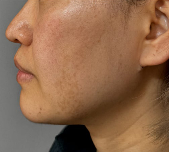 症例写真,イタリアンリフト、あご注射（ヒアルロン酸）、シワ取りヒアルロン酸注射を行った症例写真,After（3ヶ月後）,ba_italian040_b03.jpg
