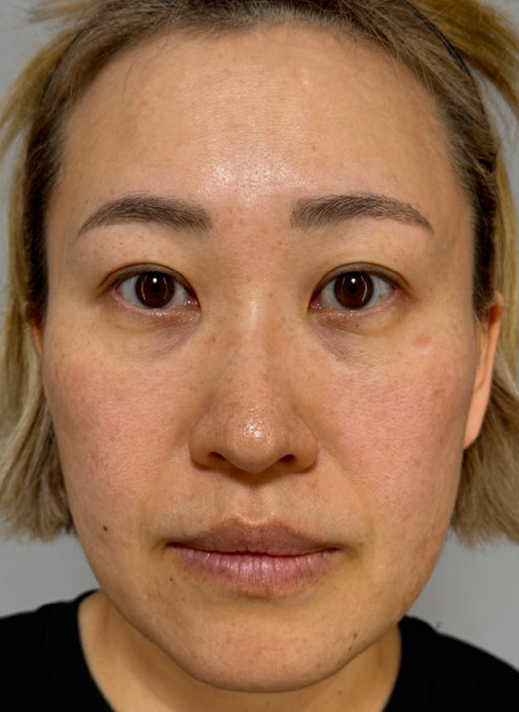 イタリアンリフト、あご注射（ヒアルロン酸）、シワ取りヒアルロン酸注射を行った症例写真,Before,ba_italian040_b01.jpg