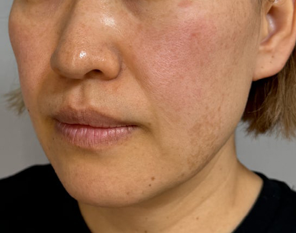 症例写真,イタリアンリフト、あご注射（ヒアルロン酸）、シワ取りヒアルロン酸注射を行った症例写真,Before,ba_italian040_b02.jpg