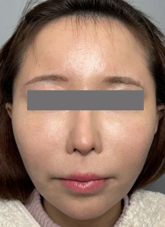 頬をふっくら・脂肪注入,顔面脂肪注入,頬に脂肪注入を行ってコケた印象を改善した症例写真,After（3ヶ月後）,ba_faceshibo006_a01.jpg