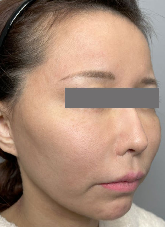 症例写真,頬に脂肪注入を行ってコケた印象を改善した症例写真,Before,ba_faceshibo006_b02.jpg
