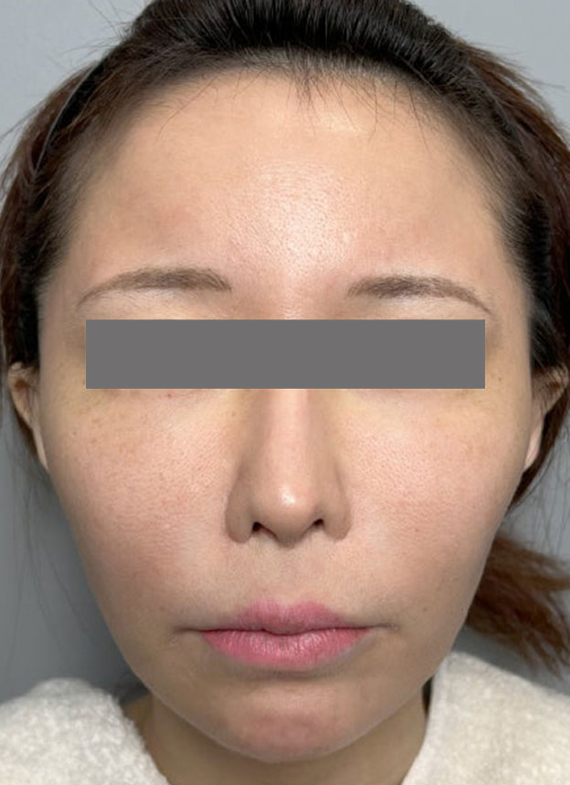 症例写真,頬に脂肪注入を行ってコケた印象を改善した症例写真,施術前,mainpic_faceshibo006a.jpg