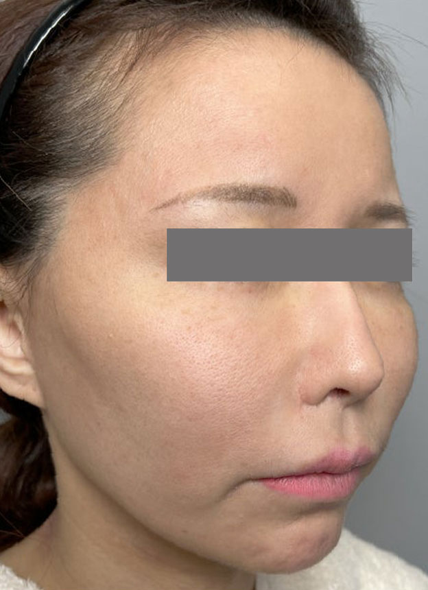 症例写真,頬に脂肪注入を行ってコケた印象を改善した症例写真,施術前,mainpic_faceshibo006e.jpg