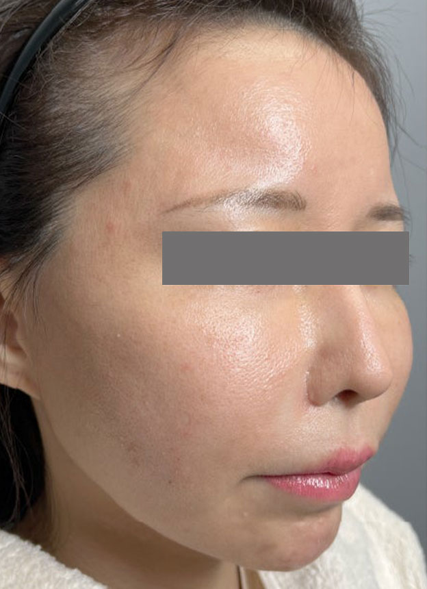 症例写真,頬に脂肪注入を行ってコケた印象を改善した症例写真,1週間後,mainpic_faceshibo006f.jpg