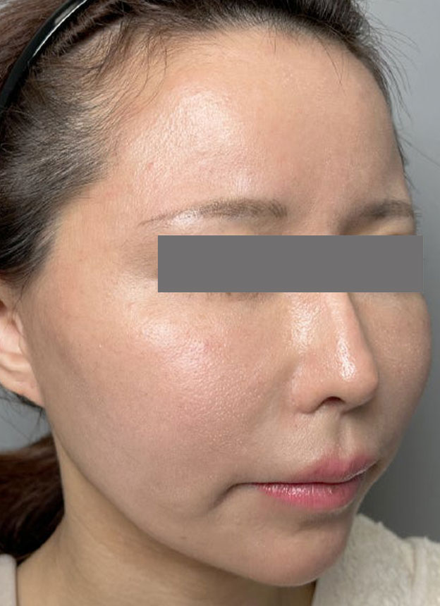 症例写真,頬に脂肪注入を行ってコケた印象を改善した症例写真,1ヶ月後,mainpic_faceshibo006g.jpg