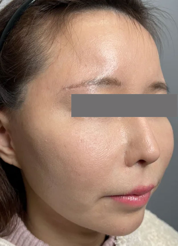 症例写真,頬に脂肪注入を行ってコケた印象を改善した症例写真,3ヶ月後,mainpic_faceshibo006h.jpg