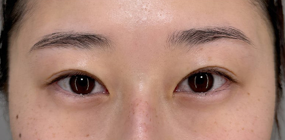 二重まぶた・埋没法（二針固定）を行い、より目力のある目元になった症例写真,After（3ヶ月後）,ba_maibotsu092_a01.jpg
