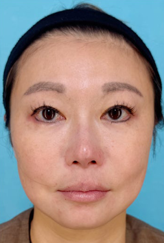 たるみが気になりはじめた40代女性にミニフェイスリフトを行った症例写真,After（3ヶ月後）,ba_minilift029_a01.jpg