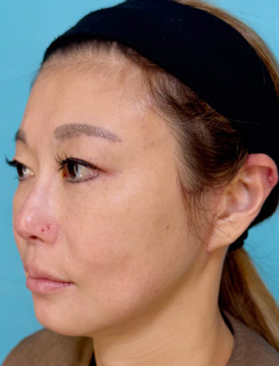 症例写真,たるみが気になりはじめた40代女性にミニフェイスリフトを行った症例写真,After（3ヶ月後）,ba_minilift029_b02.jpg