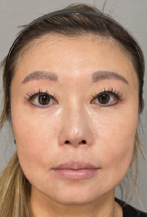 たるみが気になりはじめた40代女性にミニフェイスリフトを行った症例写真,Before,ba_minilift029_b01.jpg