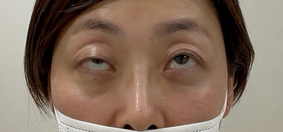 症例写真,右眼瞼の眼瞼下垂に対して埋没法を行った40代女性の症例写真,Before,ba_maibotsu093_b02.jpg
