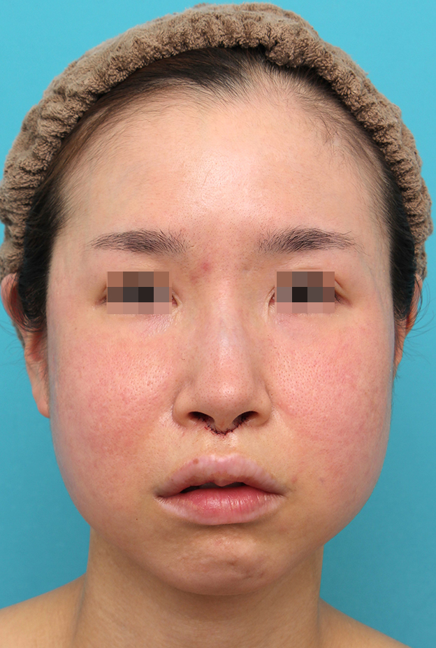 症例写真,人中短縮手術とバッカルファット除去を同時に行った30代女性の症例写真,手術直後,mainpic_hanashita014b.jpg