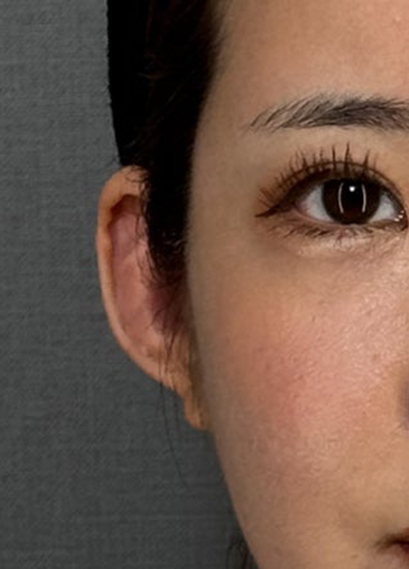 症例写真,寝ている耳を立ち耳にする手術（耳介挙上・エルフ耳）の症例写真,After（1ヶ月後）,ba_elf001_b03.jpg