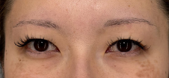 二重まぶた・全切開法でまつ毛のキワがしっかり見えるようにした症例写真,Before,ba_sekkai115_b01.jpg