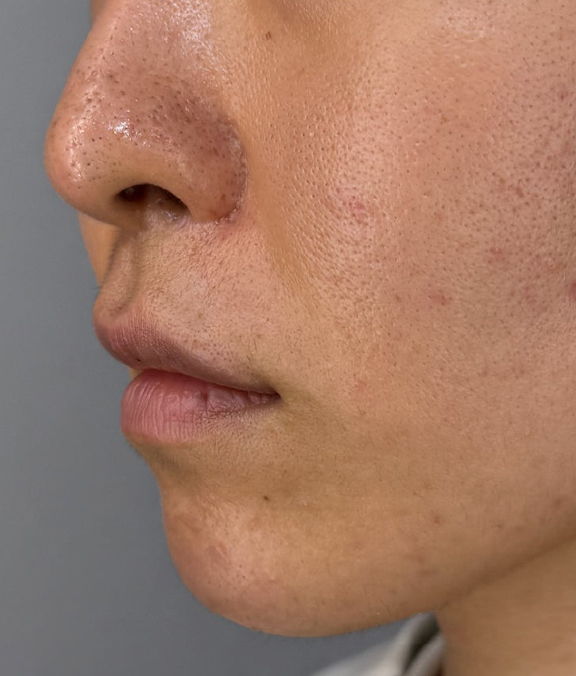 症例写真,上口唇リフト（人中短縮、リップリフト）の症例写真,After（1年後）,ba_hanashita015_b02.jpg
