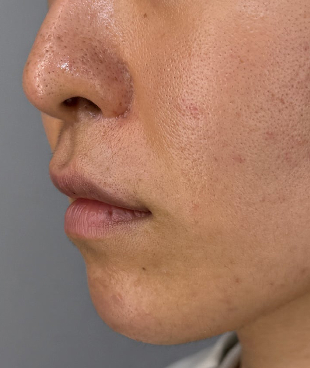 症例写真,上口唇リフト（人中短縮、リップリフト）の症例写真,1年後,mainpic_hanashita015f.jpg