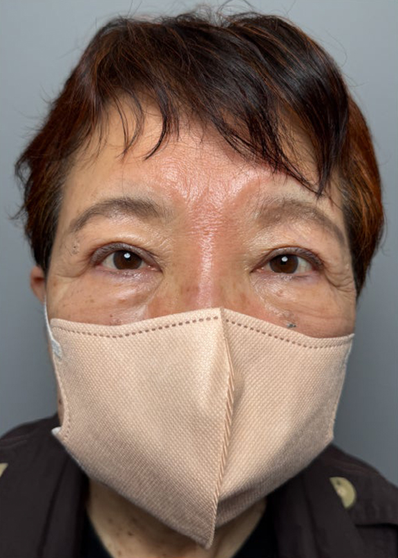 眼瞼下垂手術で末広型の二重を作り目を開きやすくした症例写真,After（1年後）,ba_ganken053_a01.jpg