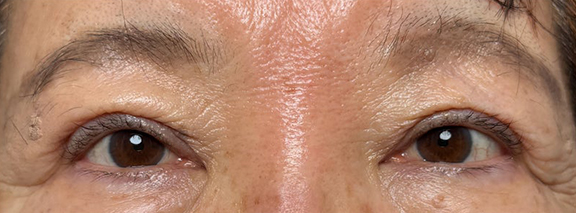 症例写真,眼瞼下垂手術で末広型の二重を作り目を開きやすくした症例写真,After（1年後）,ba_ganken053_b02.jpg