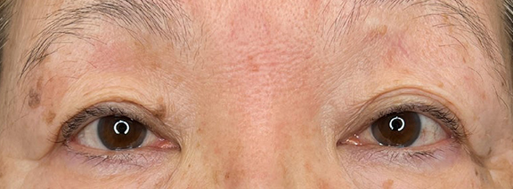 症例写真,眼瞼下垂手術で末広型の二重を作り目を開きやすくした症例写真,Before,ba_ganken053_b02.jpg