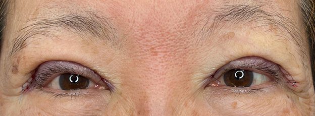 症例写真,眼瞼下垂手術で末広型の二重を作り目を開きやすくした症例写真,施術直後,mainpic_ganken053b.jpg