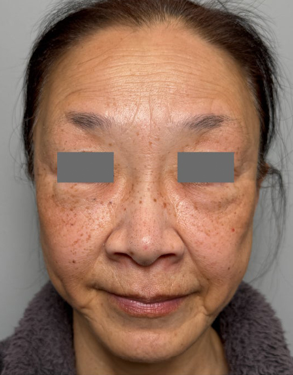 唇を薄く（口唇縮小術）,下唇を薄くした60代女性の症例写真,After（3ヶ月後）,ba_usuku030_a01.jpg