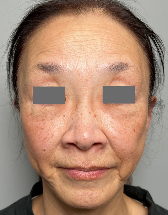 唇を薄く（口唇縮小術）,下唇を薄くした60代女性の症例写真,Before,ba_usuku030_b01.jpg