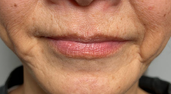 症例写真,下唇を薄くした60代女性の症例写真,Before,ba_usuku030_b02.jpg
