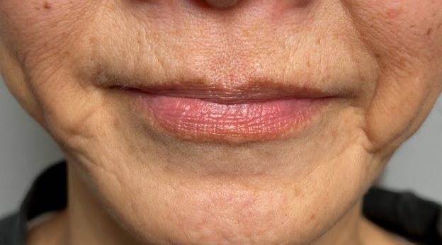 症例写真,下唇を薄くした60代女性の症例写真,施術前,mainpic_usuku030a.jpg