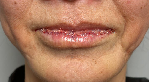 症例写真,下唇を薄くした60代女性の症例写真,施術直後,mainpic_usuku030b.jpg