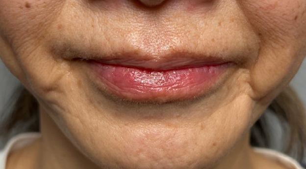 症例写真,下唇を薄くした60代女性の症例写真,2週間後,mainpic_usuku030c.jpg