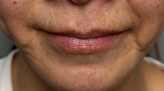 症例写真,下唇を薄くした60代女性の症例写真,1ヶ月後,mainpic_usuku030d.jpg