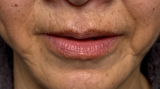 症例写真,下唇を薄くした60代女性の症例写真,3ヶ月後（口を開けた状態）,mainpic_usuku030f.jpg