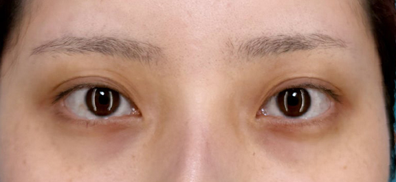 少し幅広めの二重ライン切開手術の症例写真,Before,ba_sekkai116_b01.jpg