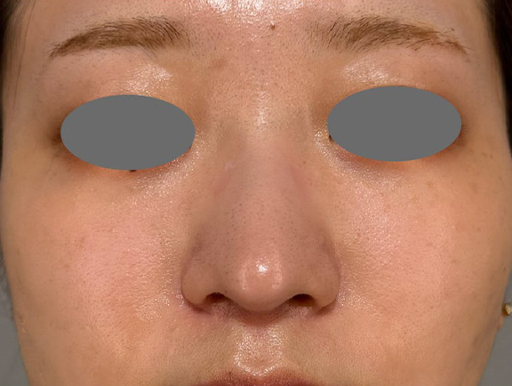 症例写真,鼻尖の高さを変えずに鼻柱を前方に出した耳介軟骨移植の症例写真,After（3ヶ月後）,ba_jikai059_b02.jpg