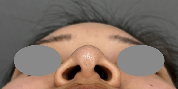 症例写真,小鼻の広がりに対して内側法で鼻翼縮小を行った症例写真,Before,ba_biyoku063_b02.jpg
