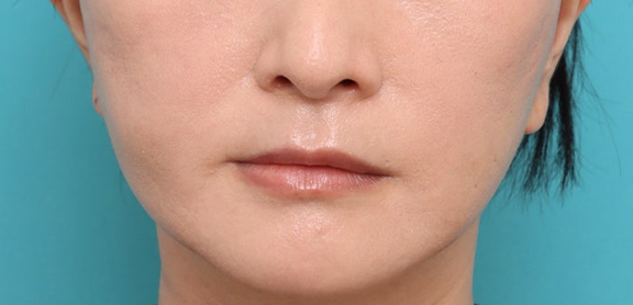 症例写真,フルフェイスリフトとジョールファット除去を行った症例写真,After（1ヶ月後）,ba_facelift010_b03.jpg