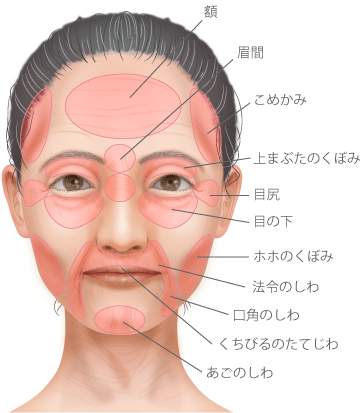 額 眉間 上まぶたのくぼみ 目尻 目の下 こめかみ法令のしわ ホホのくぼみ くちびるのたてじわ 口角のしわ あごのしわ